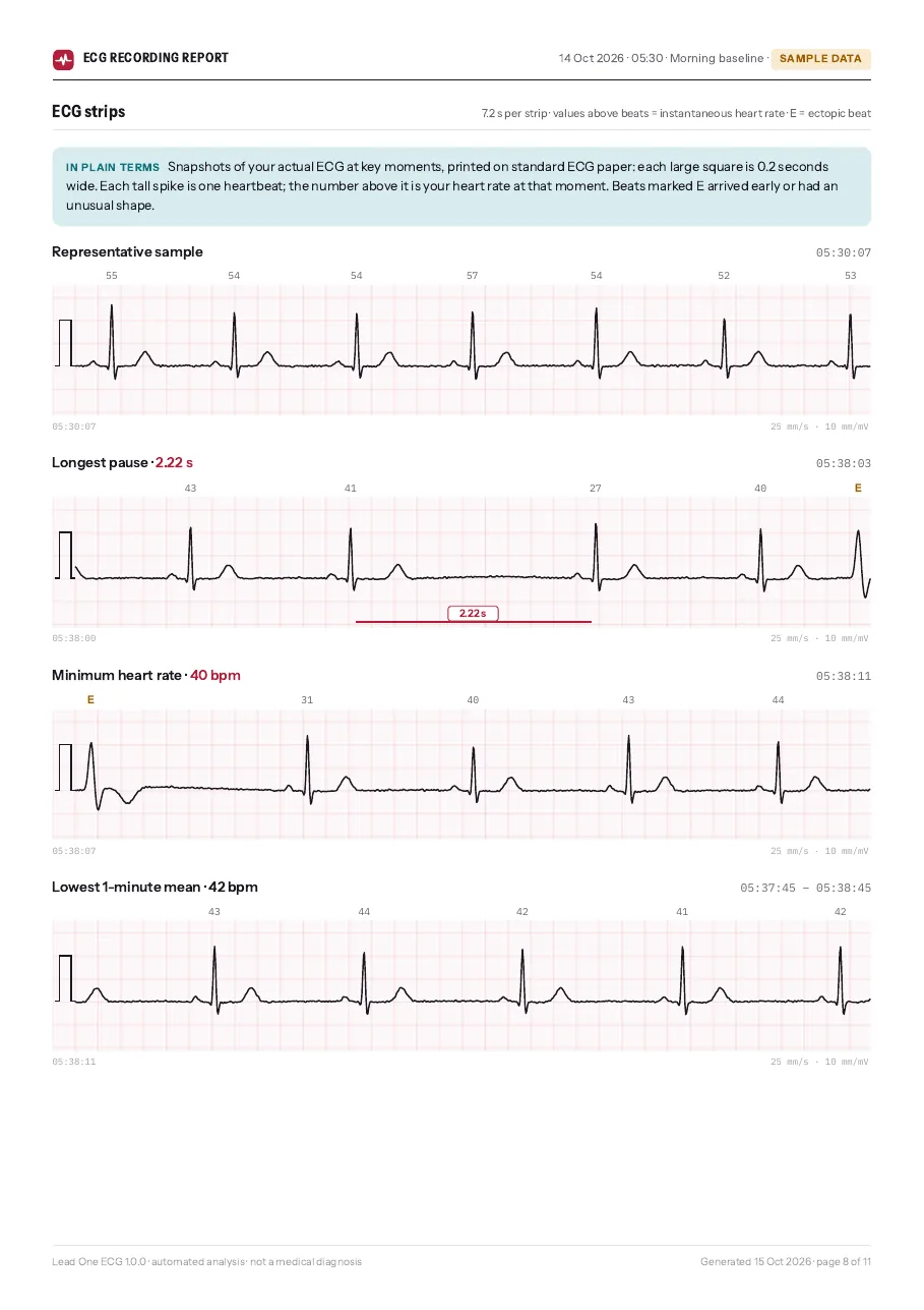 ECG strips on standard 25 mm/s paper